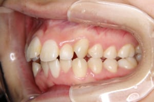 上顎前歯の突出、叢生が認められます